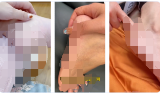 請(qǐng)勿使用皮膚干裂起皮、起屑、輕微干裂傷口等影響用戶體驗(yàn)的素材設(shè)計(jì)，如【視頻中展現(xiàn)干裂起皮、起屑場(chǎng)景】，請(qǐng)修改