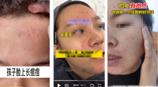 請(qǐng)勿使用痘痘/斑點(diǎn)成團(tuán)成簇影響用戶體驗(yàn)的素材設(shè)計(jì)，如【視頻中展現(xiàn)痘痘點(diǎn)形象泛紅成簇、斑點(diǎn)密集場(chǎng)景】，請(qǐng)修改